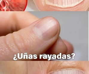 Estrías y Rayas en las Uñas: ¿Qué Indican?