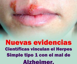 Nuevas evidencias científicas vinculan el herpes simple tipo 1 con el mal de Alzheimer.