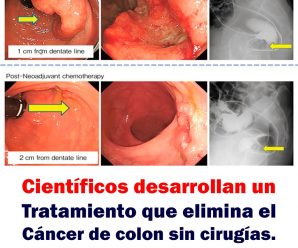 Científicos desarrollan un tratamiento que elimina el cáncer de colon sin cirugías.