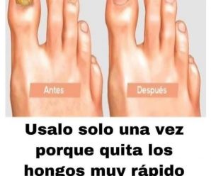 Remedio natural para ayudar a eliminar el hongo en las uñas