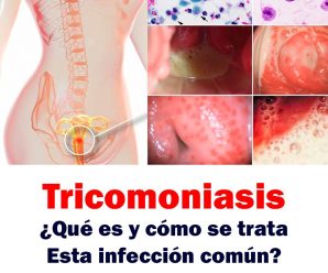 Tricomoniasis: ¿Qué es y cómo se trata esta infección común?