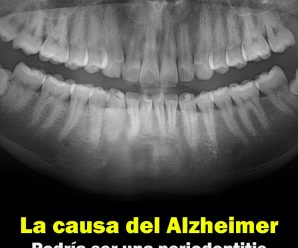 Científicos revelan que la causa del Alzheimer podría ser una periodontitis crónica.