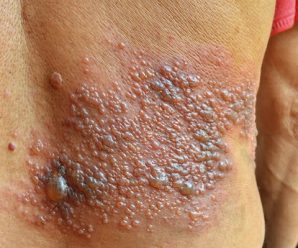 Herpes Zóster (Culebrilla): cómo tratar esta dolorosa enfermedad.