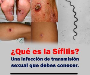 ¿Qué es la Sífilis? Una infección de transmisión sexual que debes conocer.