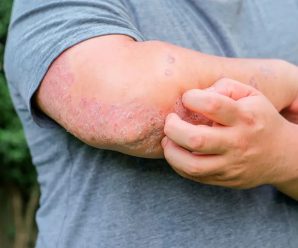 “Psoriasis: Causas, Tratamientos y Remedios Naturales para Aliviarla”