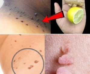 Eliminar verrugas de forma natural: 8 sorprendentes beneficios del limón y el jengibre