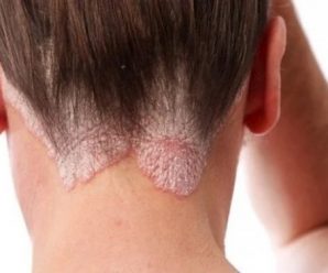 “¿Problemas en el Cuero Cabelludo? Descubre el Misterio de la Dermatitis Seborreica”