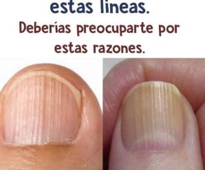 ¿Tienes líneas en las uñas? debes solucionarlo