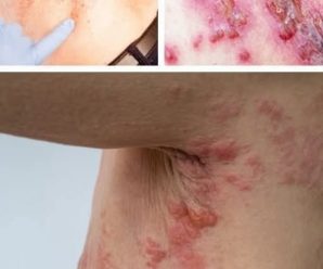 El estrés: el desencadenante silencioso del herpes zóster y sus síntomas….