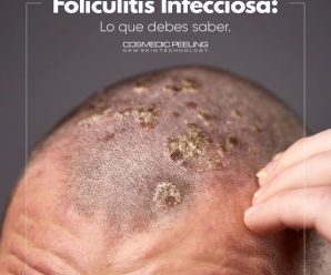 Foliculitis la infección silenciosa que podría acabar con tu…