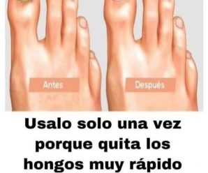 A esto le llaman el ROMPE HONGOS porque elimina todos los hongos de las uñas de una vez