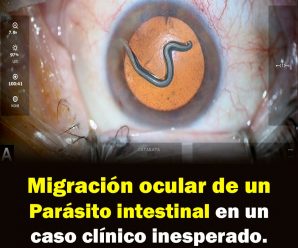 Migración ocular de un parásito intestinal en un caso clínico inesperado.