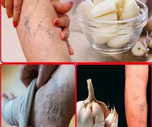 Elimina las varices con este remedio casero y luce unas piernas increíbles