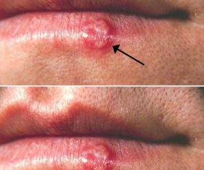 Aftas y herpes bucales: causas y remedios naturales para aliviarlos.