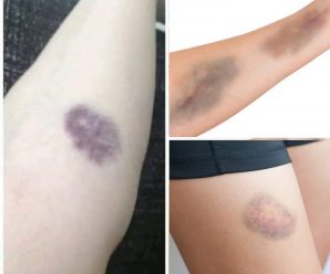 ¡Atención! Si te aparecen moretones en los brazos sin razón, podría ser una señal de alerta