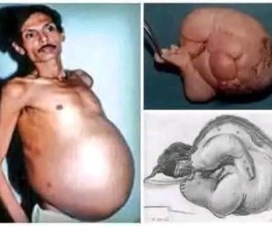 🧬 El hombre que vivió con un feto dentro por 36 años…Ver más