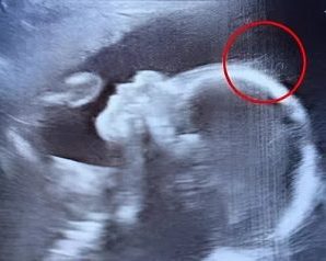 Los doctores no podían creer lo que vieron durante el ultrasonido. Pero cuando nació la bebé, su encanto, fuerza e historia tocaron corazones en todo el mundo de la forma más inesperada.