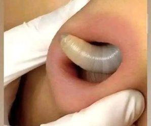 Encuentran larva en una joven muj…Ver más