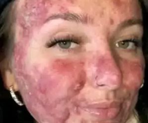 Le picaba el cuerpo, pensaba q era alergia diagnosticaron ca…ver mas