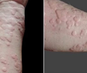 Combatiendo la Urticaria con El Poder Curativo de la Ortiga