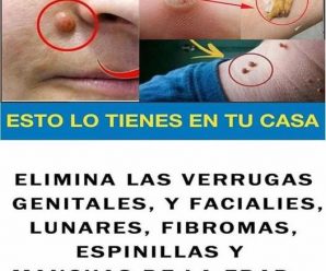 Elimina las verrugas genitales y faciales, lunares, fibromas, espinillas y manchas, con esto