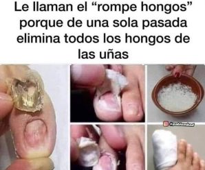 ESTE REMEDIO DESAPARECE HONGOS EN LA CABEZA, MANOS, UÑAS Y PIES RAPIDÍSIMO ¡TE LO RECOMIENDO!