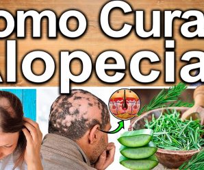 COMO CURAR LA ALOPECIA Y CAIDA DE CABELLO – 5 Soluciones Para La Perdida De Cabello