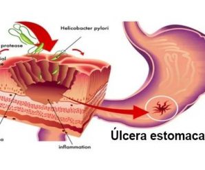 MEDICO JAPONÉS FILTRA REMEDIO NATURAL PARA DESTRUIR LA BACTERIA HELICOBACTER PYLORI