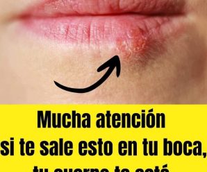 Cura el Herpes Labial con Estos Remedios Caseros Infalibles