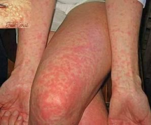 Le picaba todo el cuerpo, pensaba que era alergia, pero la verdad era otra.