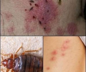 El invasor invisible: ¿Qué esconden realmente las picaduras de chinches?