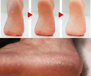 Cómo Eliminar los Callos de los Pies de Forma Natural: Métodos Efectivos y Consejos Prácticos