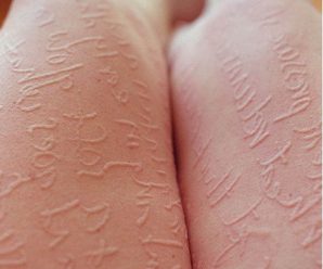 Causas del dermografismo urticaria: La alergia que escribe en la piel.