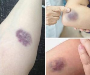 Estos son los primeros síntomas de cáncer que muchos ignoran