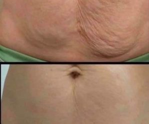 Elimina el gordito de los brazos y la flacidez