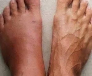 Señales de Alerta de un Hígado Dañado: ¡Aprende a Identificarlas!