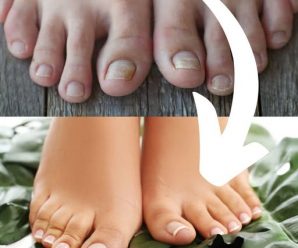 5 REMEDIOS CASEROS PARA COMBATIR LOS HONGOS EN LAS UÑAS