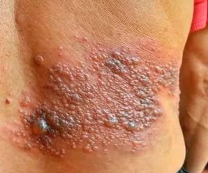 La picazón en el cuerpo puede ser síntoma de una alergia, pero también de otras enfermedades.