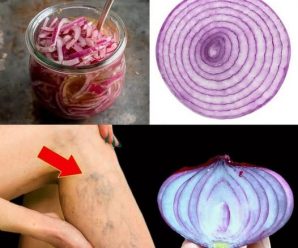 “Adiós a las varices: métodos efectivos y consejos prácticos para eliminarlas de raíz”