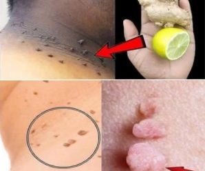 Remedio natural para remover verrugas