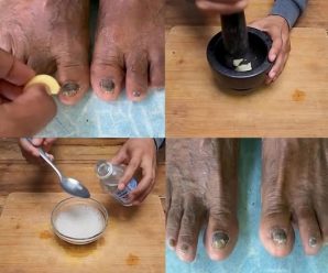 Realiza estos remedios naturales y dile adios a los hongos de tus uñas