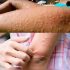 ¿Por qué aparece la urticaria en la piel? Estos son los Factores Sorprendentes que Desconoces.