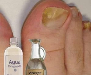 Sufres de hongos en las uñas tienes que hacer esto.