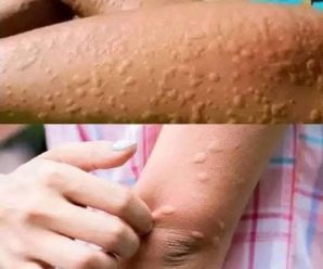 ¿Por qué aparece la urticaria en la piel? Estos son los Factores Sorprendentes que Desconoces.