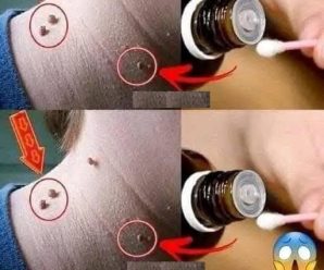 Olvídate de las cirugías: esto es lo que tienes que hacer para eliminar una verruga