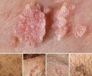Todo lo que Debes Saber sobre el Herpes Genital.