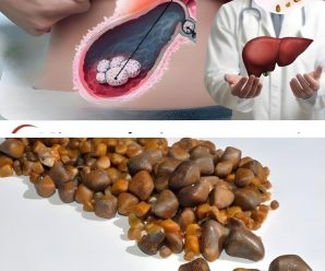 Cómo eliminar las piedras en los riñones de forma natural: guía completa para tu bienestar renal