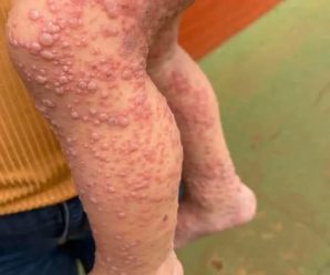 Pensó que era una simple alergia, pero su cuerpo le estaba avisando otra cosa